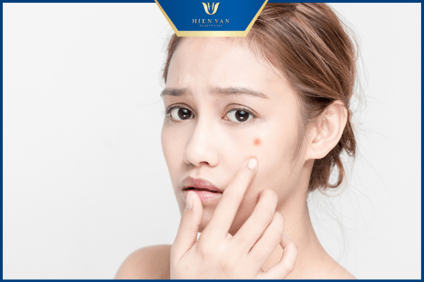 cách trị thâm mụn cho da dầu