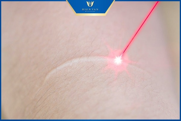 công nghệ trị sẹo trắng