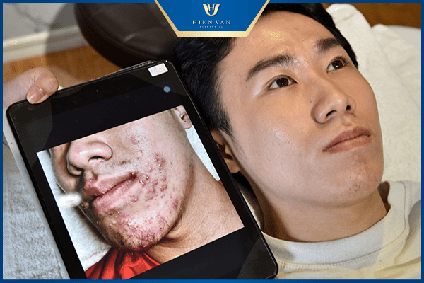 điều trị mụn viêm