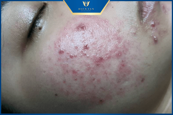 hiện tượng sau peel da bị ngứa