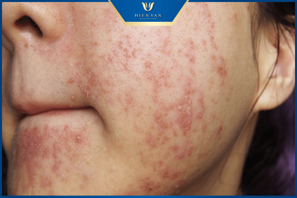 kích ứng sau peel