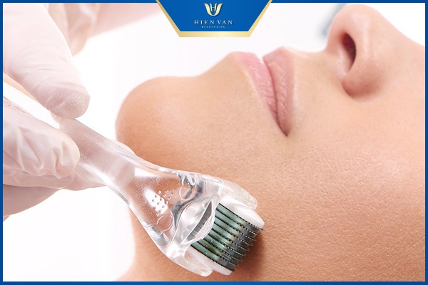 microneedling ice pick scars