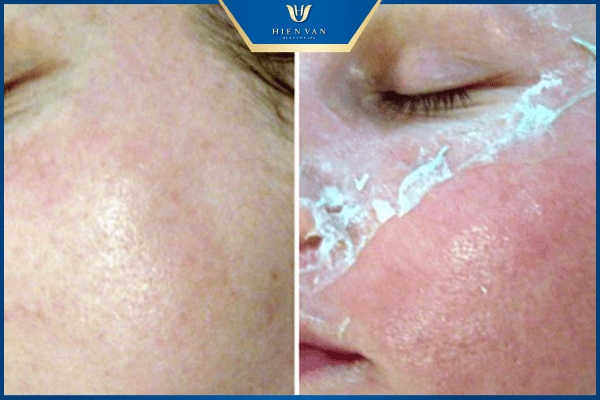 peel da bị bỏng phải làm sao 