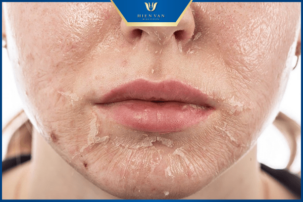 tác dụng phục peel da tại nhà