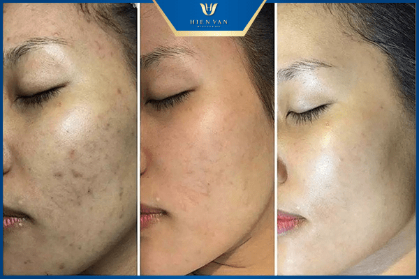 peel da mặt có tốt không 