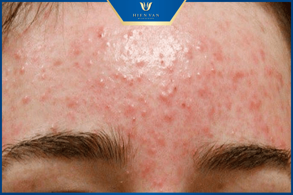peel da trị mụn là gì