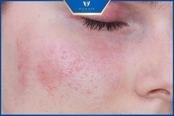 retinol có trị sẹo rỗ không