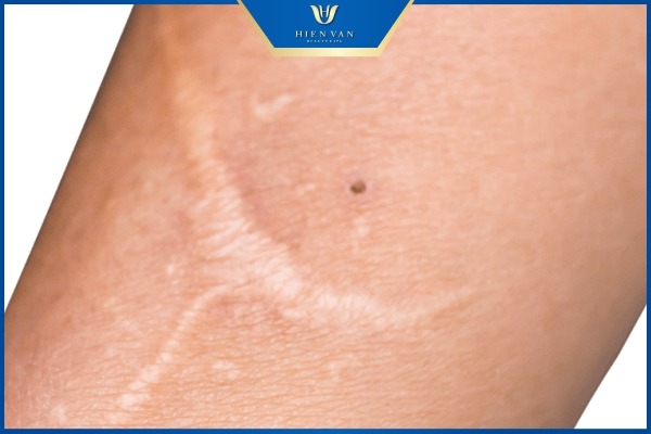 sẹo trắng là gì