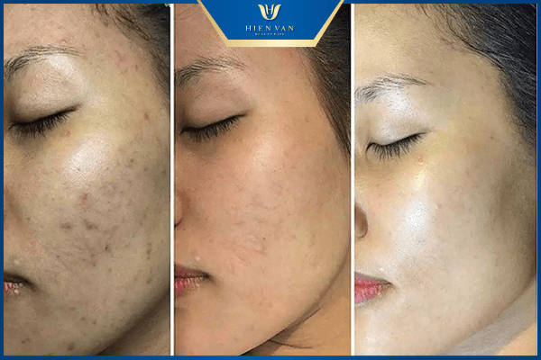 tác dụng của peel da trị mụn