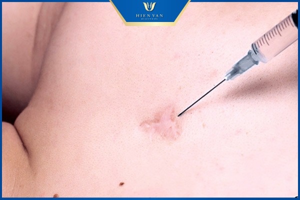 trị sẹo trắng