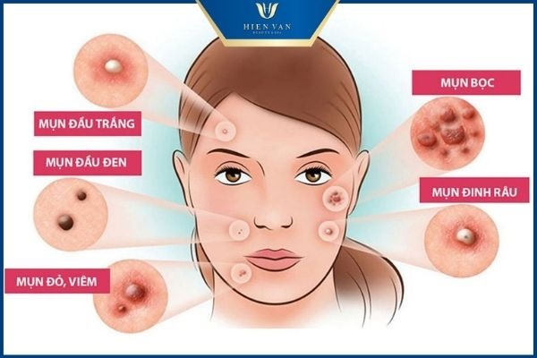 các loại mụn