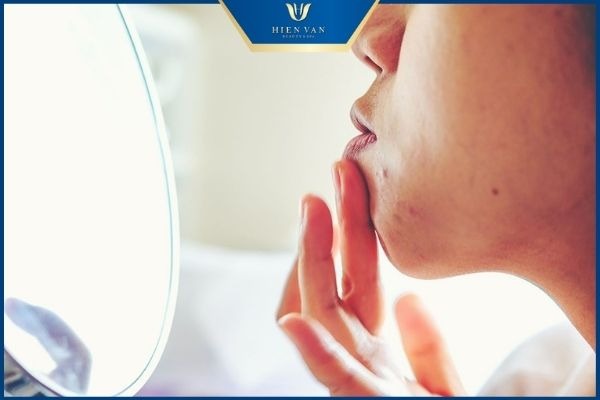 chăm sóc da sau nặn mụn