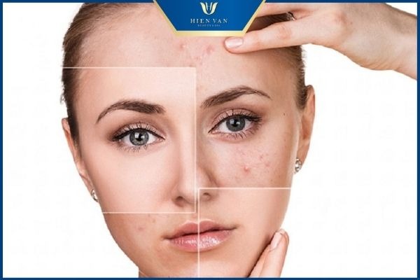 nặn mụn sai cách