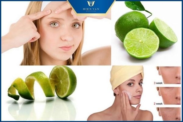 trị thâm mụn tại nhà