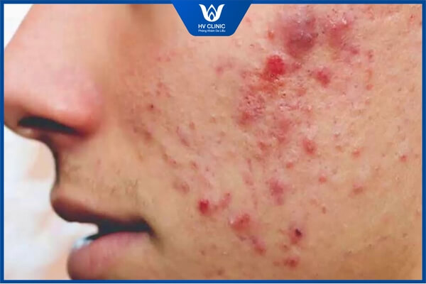 cach dung mo tran tri mun