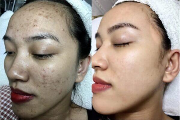 Anh truoc va sau dieu tri mun