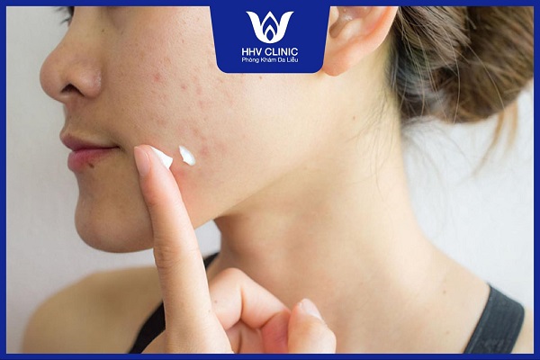 dap mat na xong co nen boi thuoc tri mun