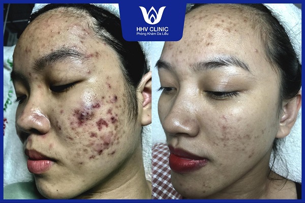 kham da lieu tri mun bao nhieu tien