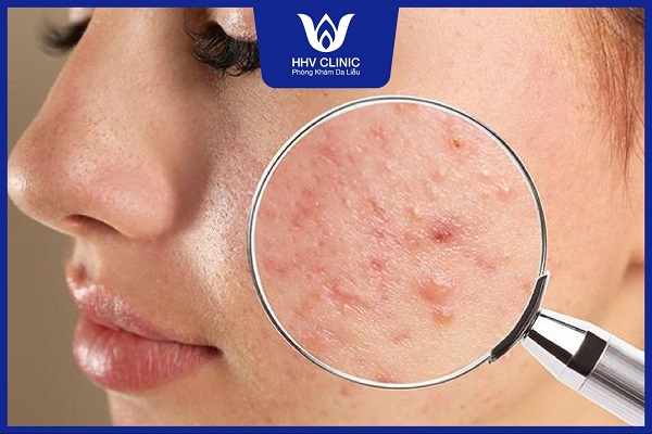 mun sung do khong nhan