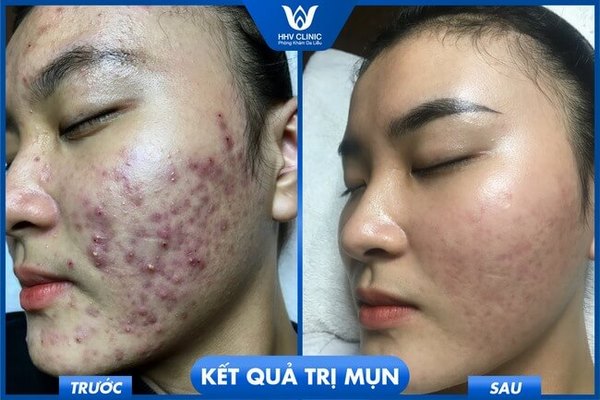 nuoc vo gao co tri mun khong