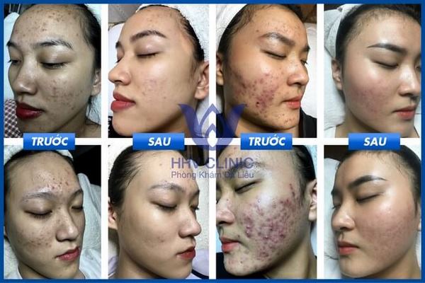 thuc an tri mun