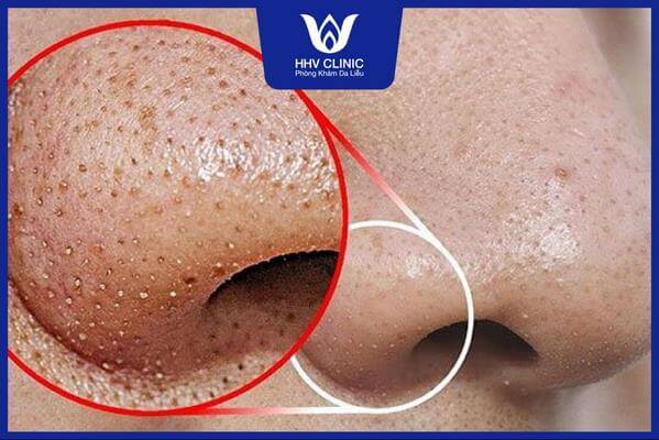 cach tri mun dau den va lo chan long to 3