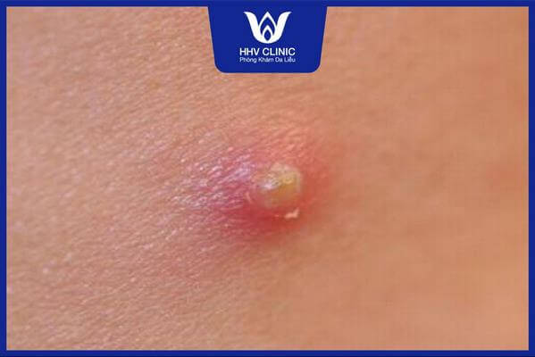 cach tri mun dau dinh o mong