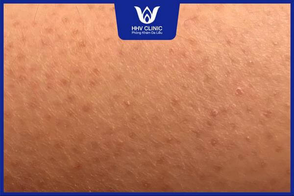 cach tri mun mong va tham mong