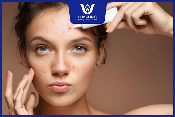 dung serum truoc hay sau kem tri mun