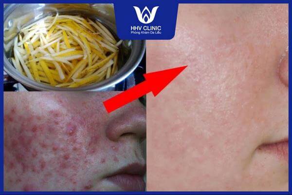 xong mat tri mun tham 