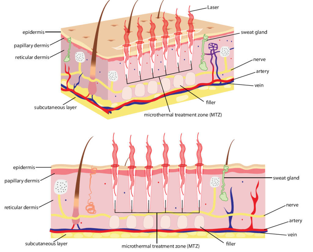 Cơ chế của trẻ hóa da bằng Laser
