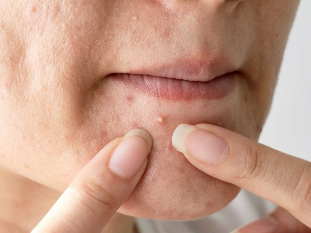 Nguyên nhân gây mụn đầu trắng