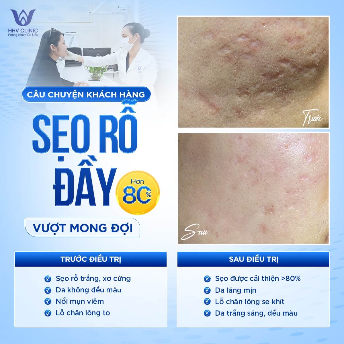 Cắt đáy sẹo rỗ giá bao nhiêu 