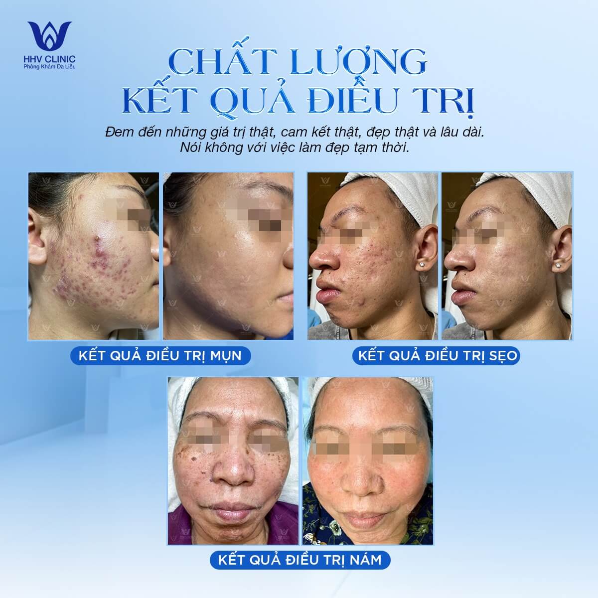 HHV luôn mang lại hiệu quả cho khách hàng khi điều trị mụn 