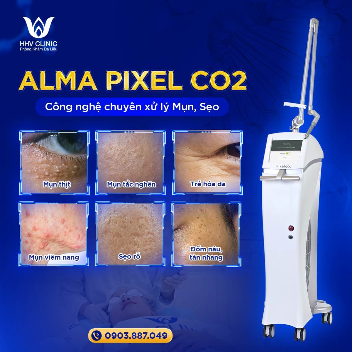 Sạch mụn, không sẹo cùng HHV Clinic