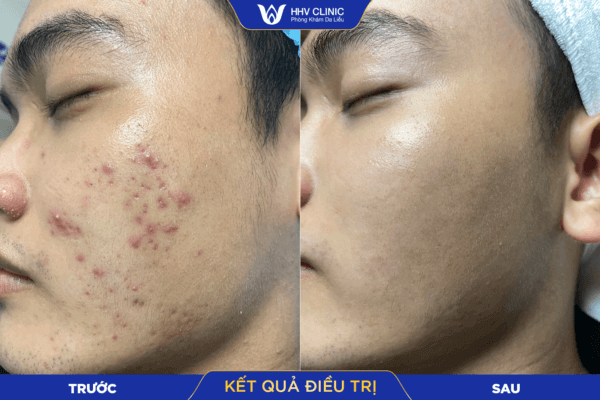 Khách hàng trị thâm mụn  tại HHV Clinic 