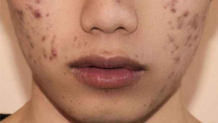 Thuốc trị thâm mụn trứng cá 