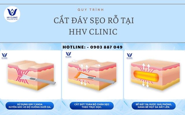 Quy trình cắt đáy sẹo rỗ tại HHV Clinic 